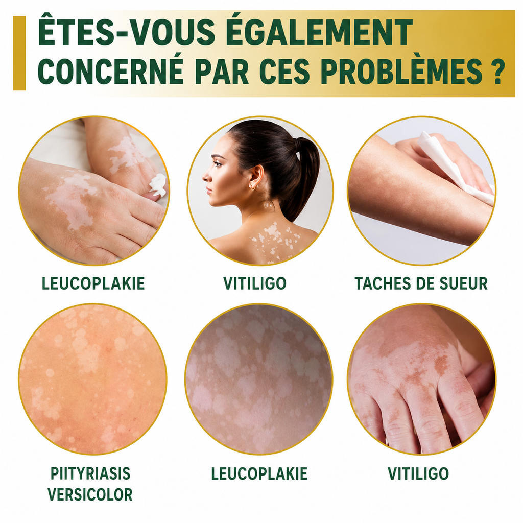 VITILIGO RELIEF CREAM