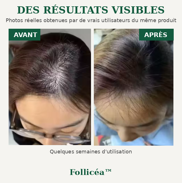 Follicéa™ — Réveillez le potentiel de vos cheveux / Pack de 3 Sérum  de traitement de perte de cheveux